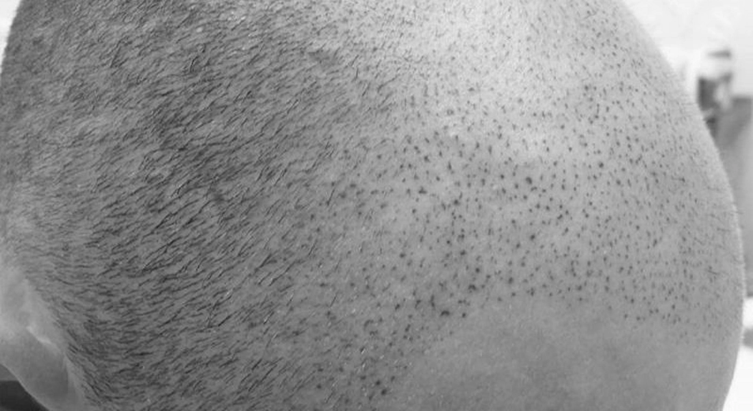 Tricopigmentazione Correttiva 1
